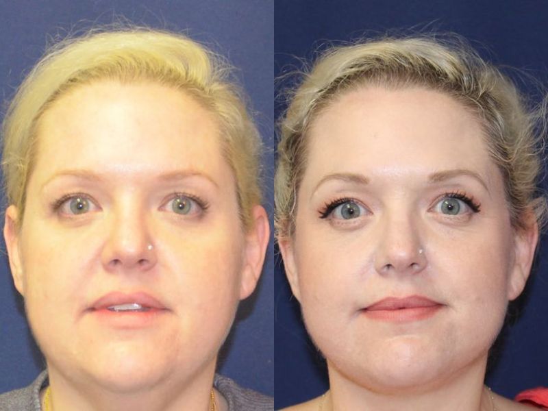 Facelift Before & After