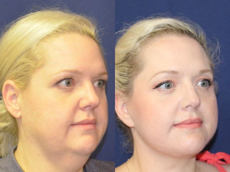 Facelift Before & After