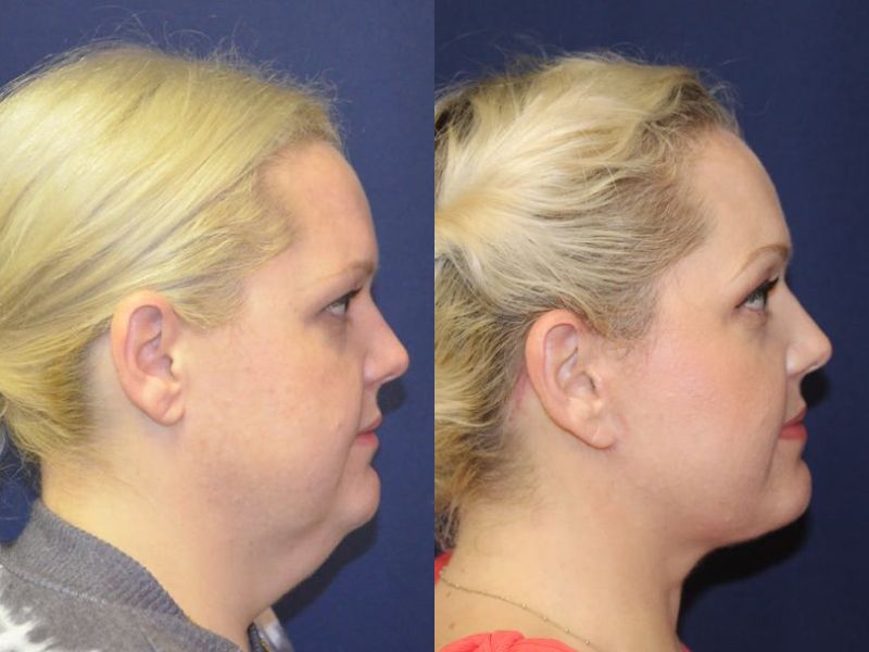 Facelift Before & After