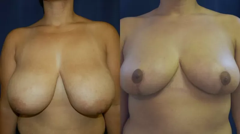 Breast Reduction Before & After