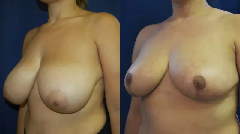 Breast Reduction Before & After
