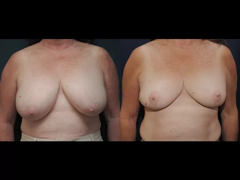 Breast Reduction Before & After