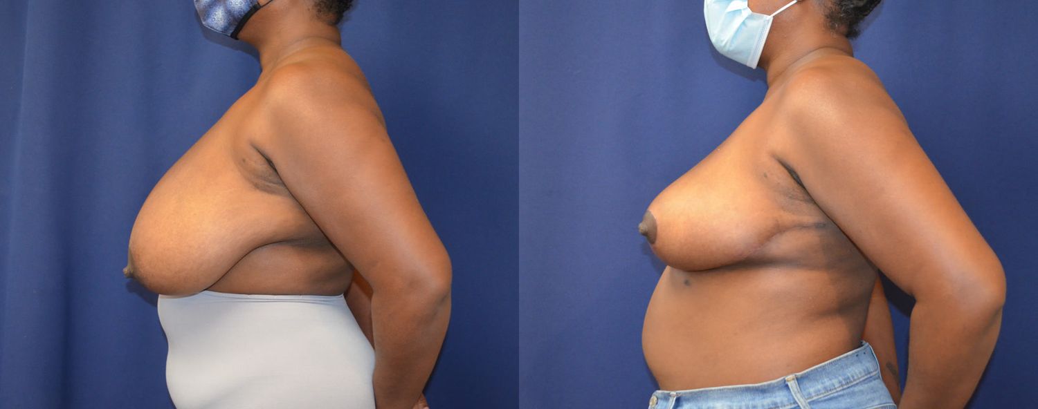 Breast Reduction Before & After