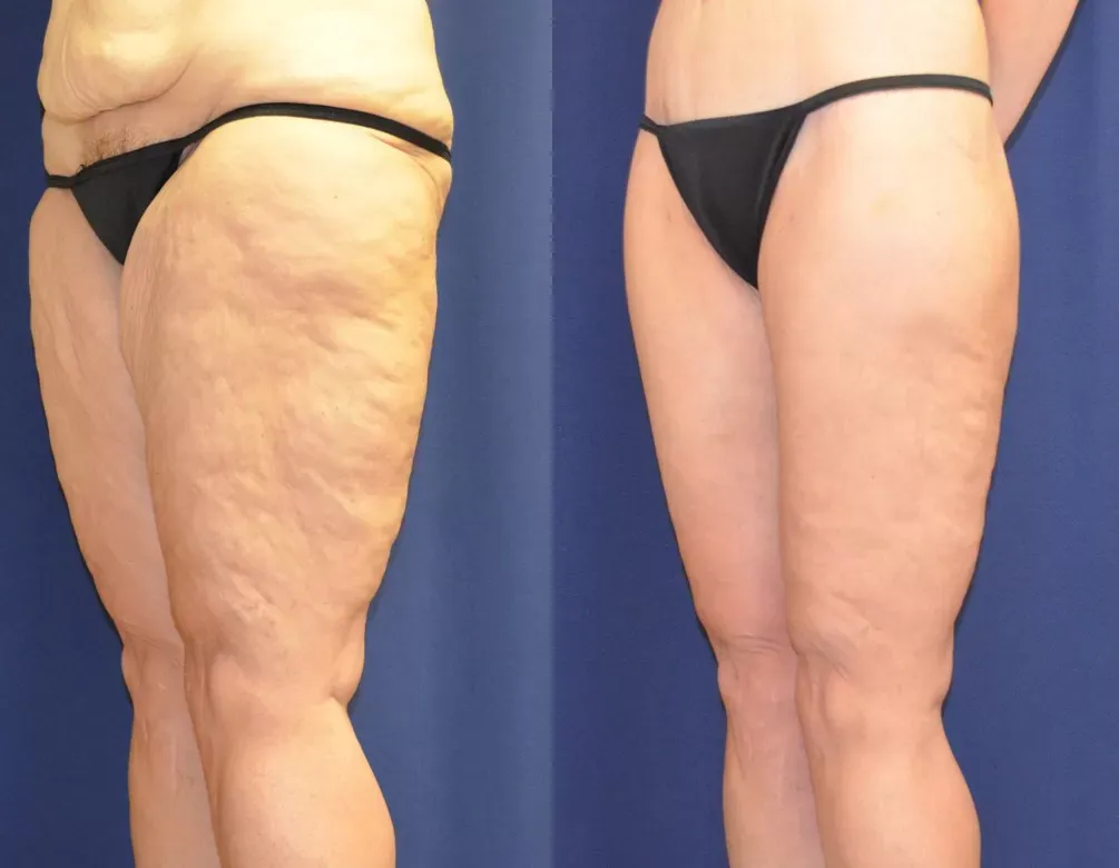 Liposuction Before & After
