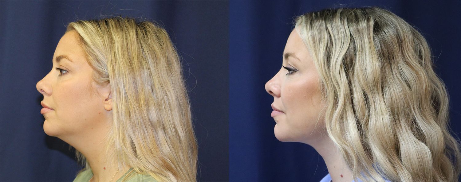 Liposuction Before & After