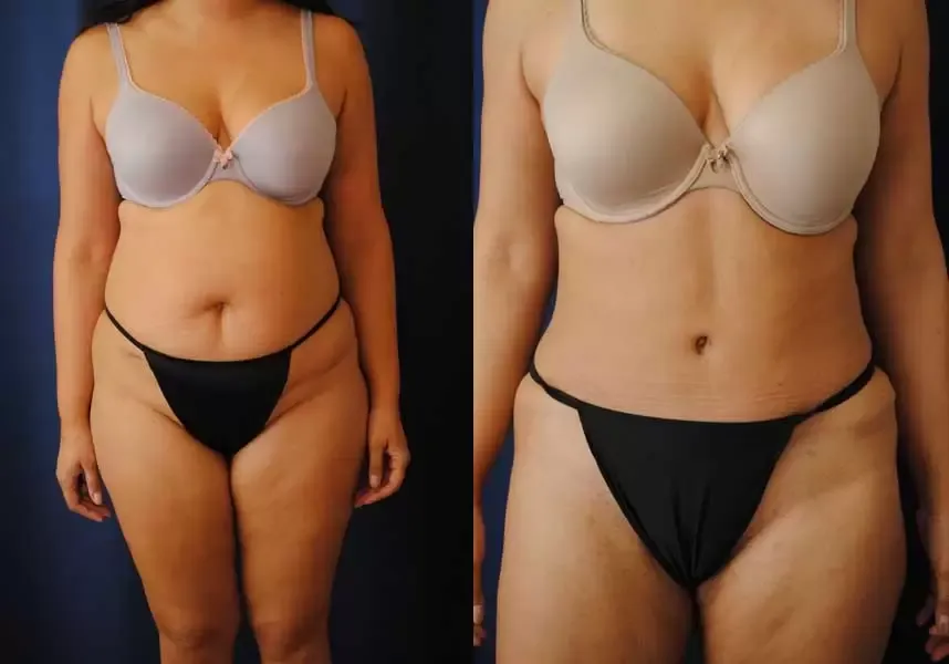 Liposuction Before & After