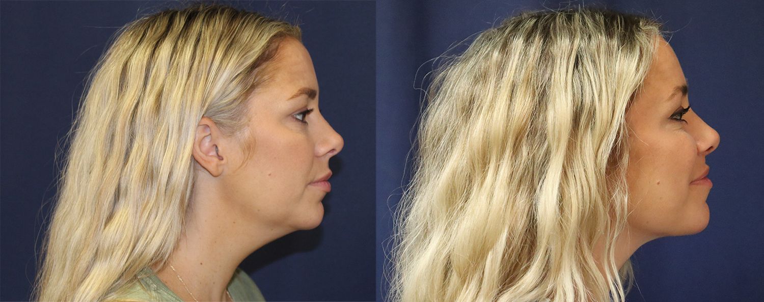 Liposuction Before & After