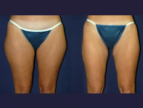Liposuction Before & After