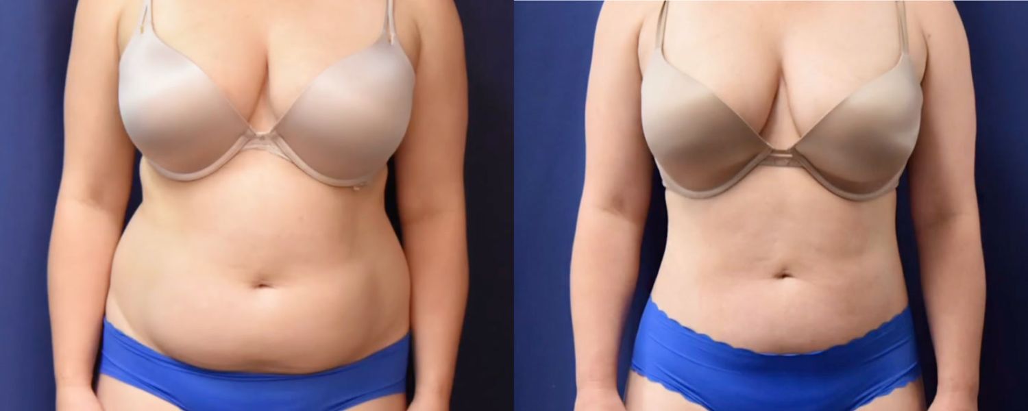 Liposuction Before & After