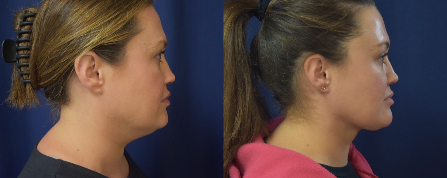 Liposuction Before & After