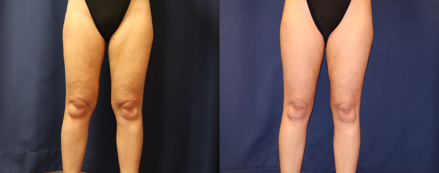 Liposuction Before & After