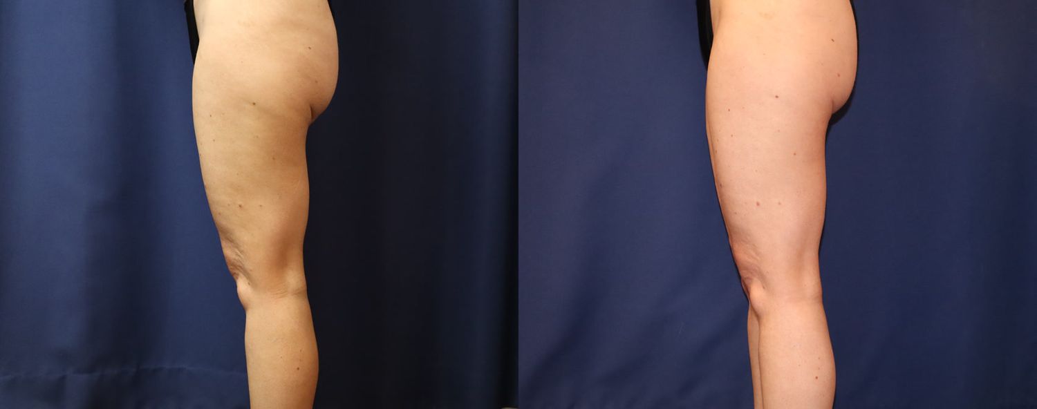 Liposuction Before & After