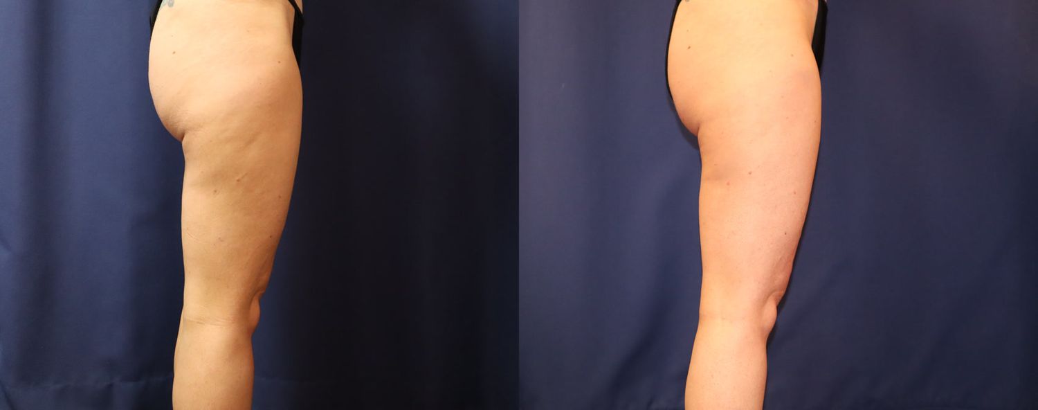 Liposuction Before & After