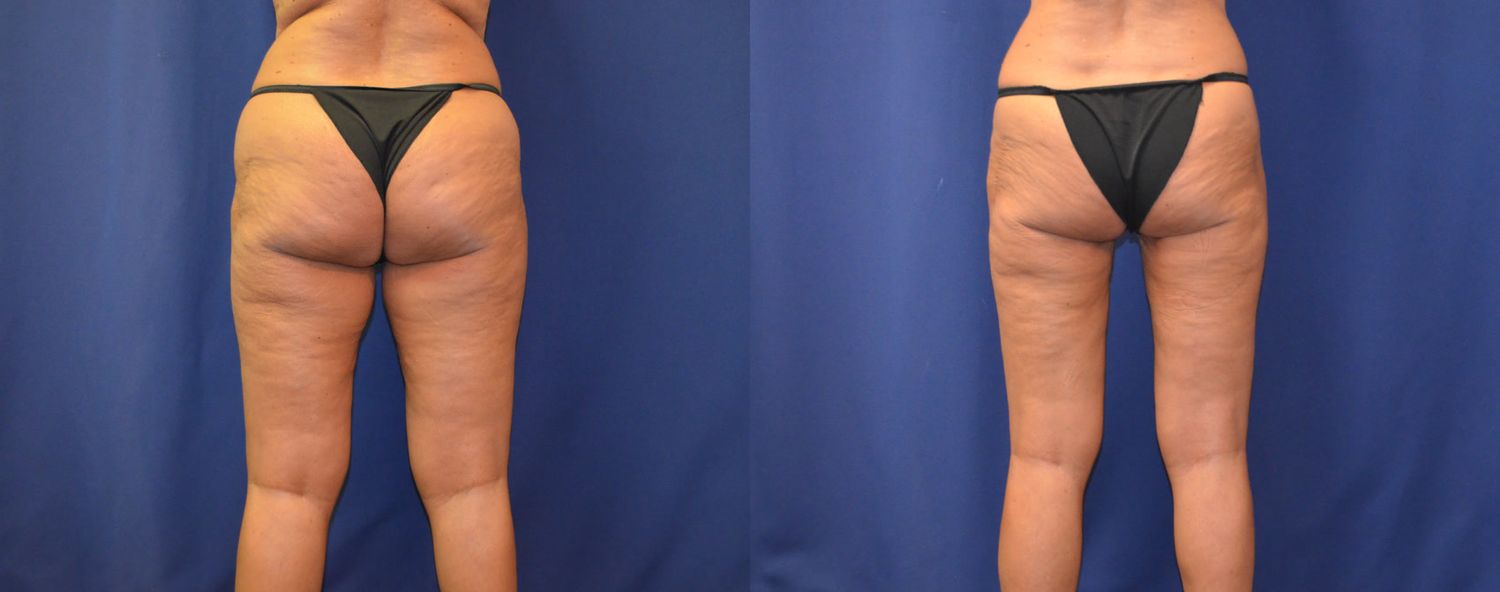Liposuction Before & After