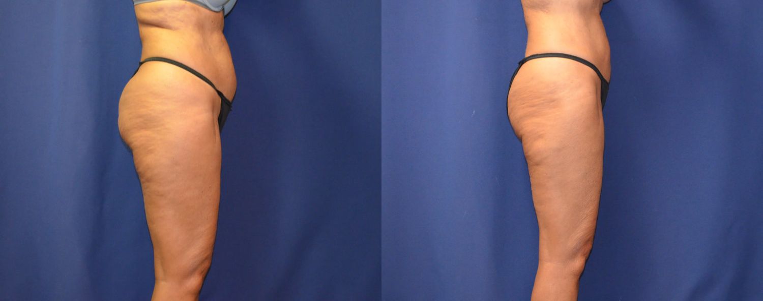 Liposuction Before & After