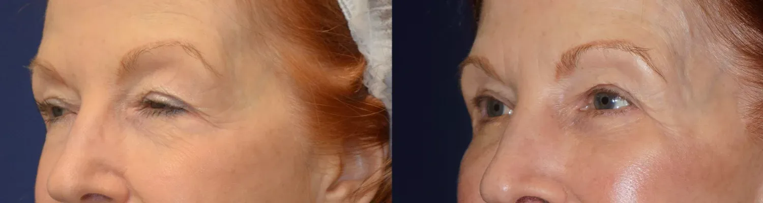 Eyelid Surgery Before & After