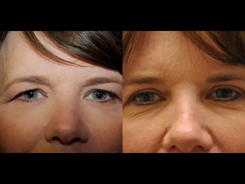 Eyelid Surgery Before & After