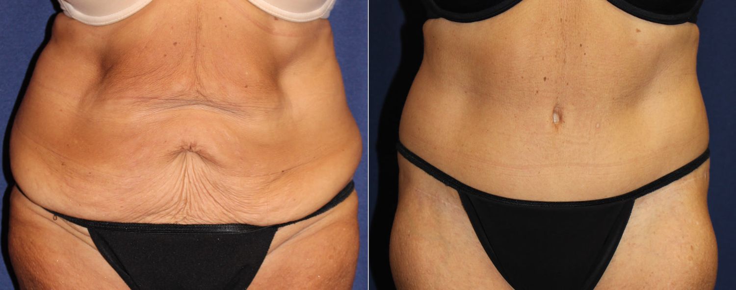 Circumferential Abdominoplasty Before & After