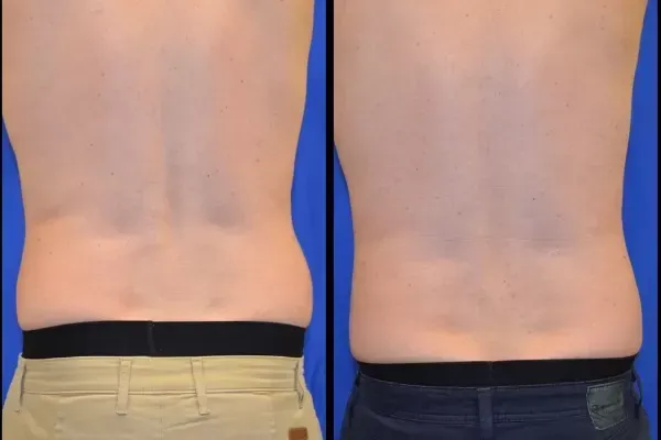 Coolsculpting For Men Before & After