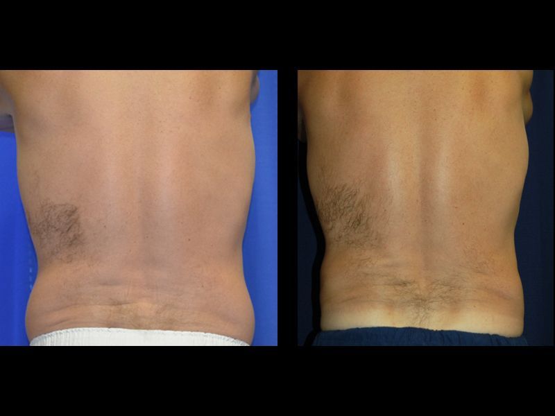 Coolsculpting For Men Before & After