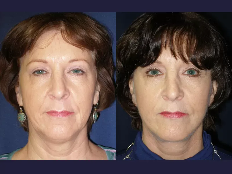 Neck Lift Before & After