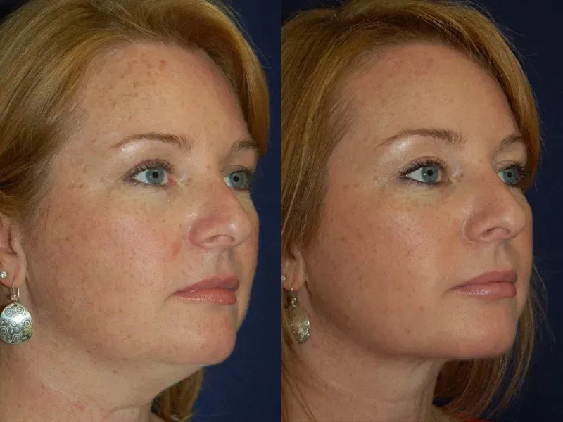 Neck Lift Before & After