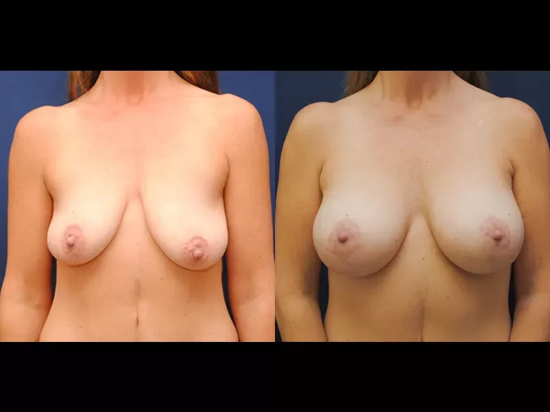 Breast Augmentation Lift Before & After