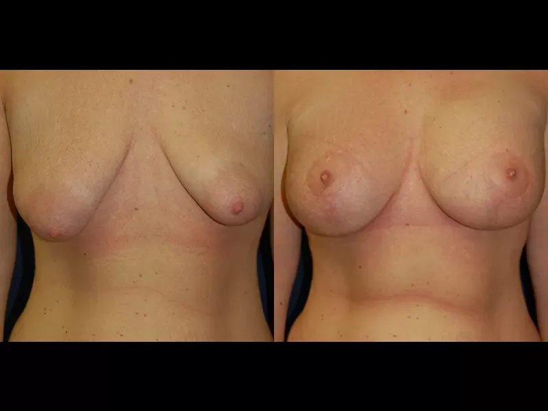Breast Augmentation Lift Before & After