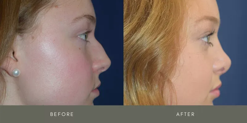 Rhinoplasty Before & After