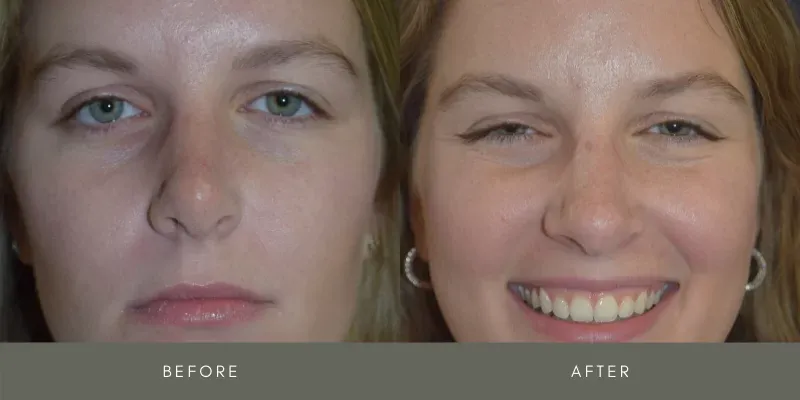Rhinoplasty Before & After
