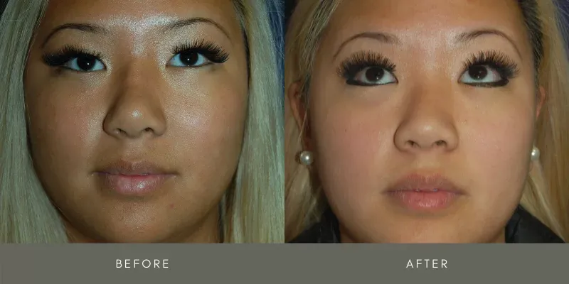 Rhinoplasty Before & After