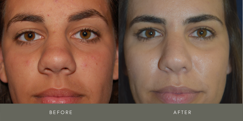 Rhinoplasty Before & After