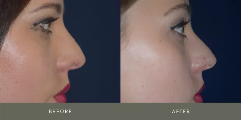 Rhinoplasty Before & After
