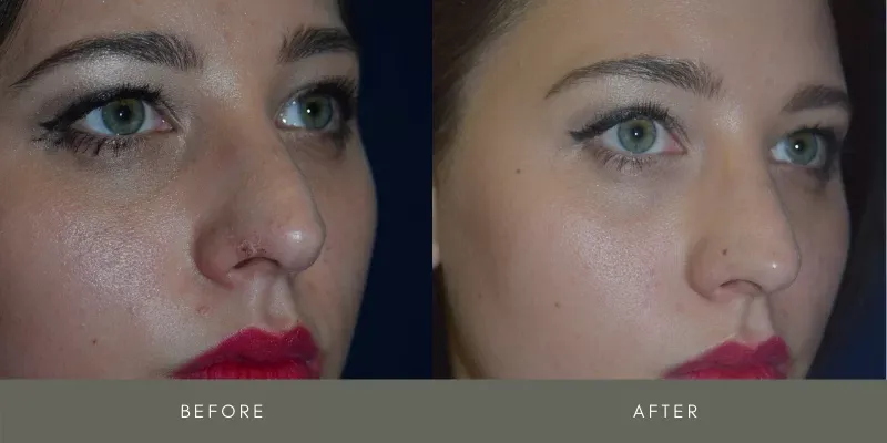 Rhinoplasty Before & After