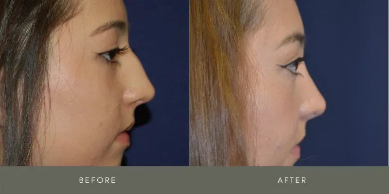 Rhinoplasty Before & After