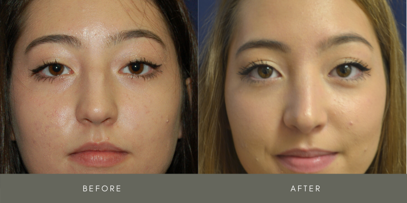 Rhinoplasty Before & After