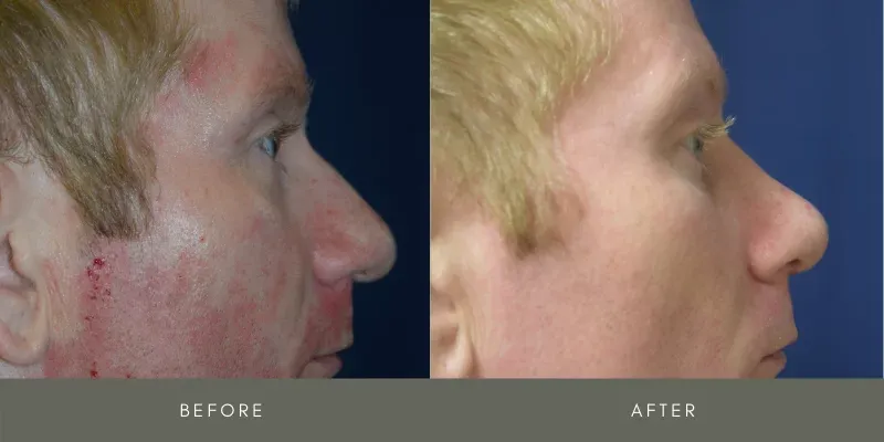 Rhinoplasty Before & After