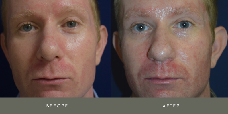 Rhinoplasty Before & After