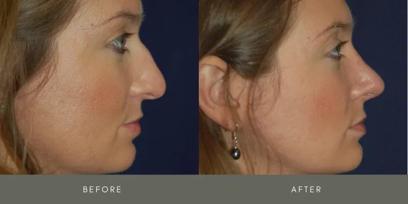 Rhinoplasty Before & After