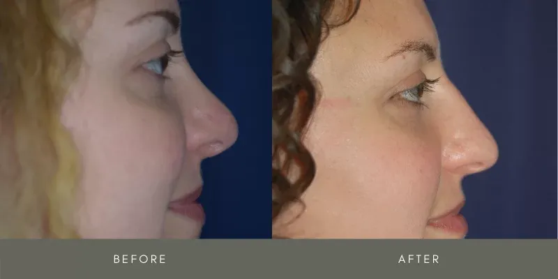 Rhinoplasty Before & After