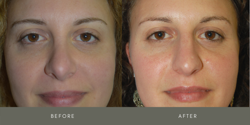 Rhinoplasty Before & After