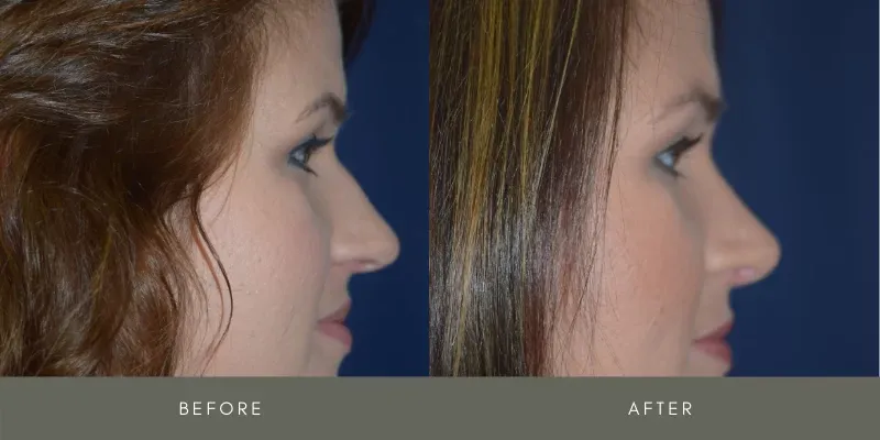 Rhinoplasty Before & After