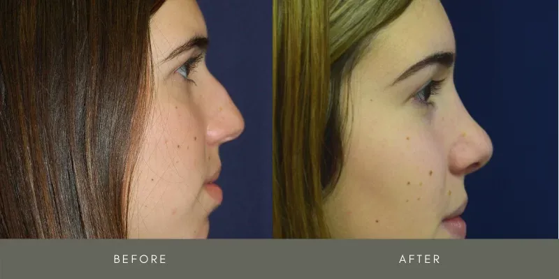 Rhinoplasty Before & After