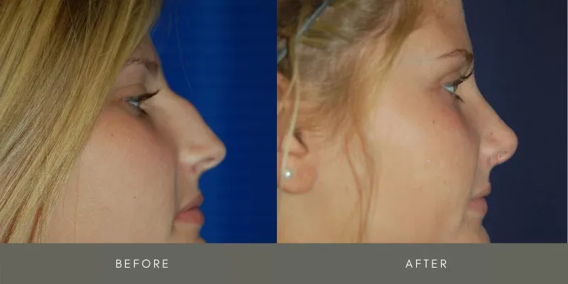 Rhinoplasty Before & After