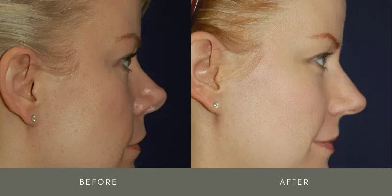 Rhinoplasty Before & After