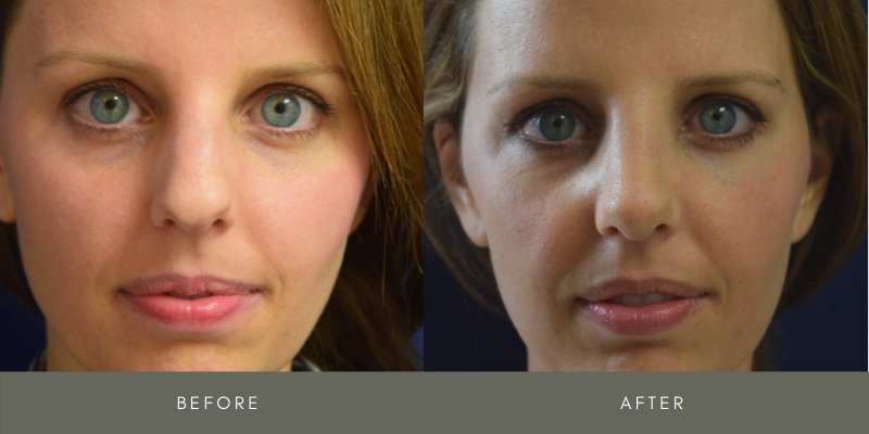 Rhinoplasty Before & After