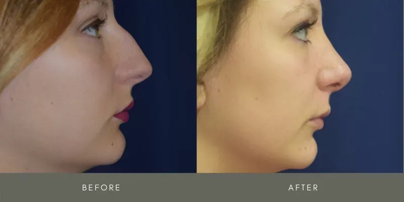 Rhinoplasty Before & After