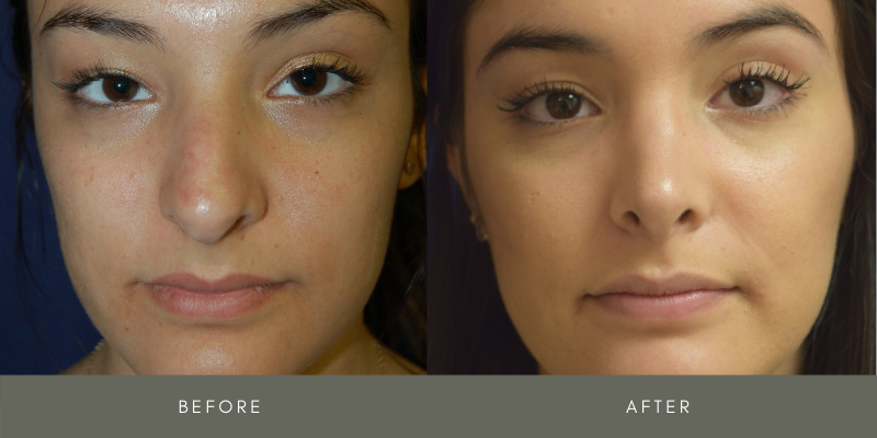 Rhinoplasty Before & After