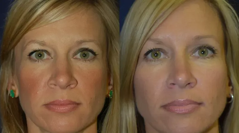 Rhinoplasty Before & After