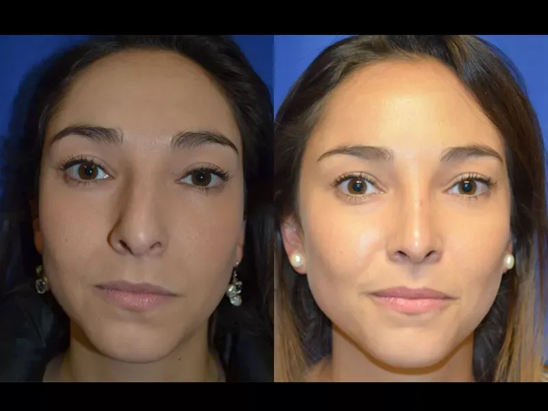 Rhinoplasty Before & After